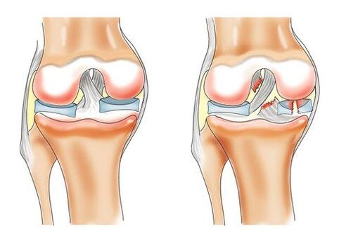 zdravé koleno a artróza kolenního kloubu
